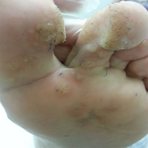 planar warts