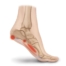 plantar fasciitis